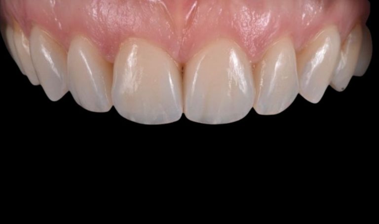 Faccette Dentali 46 Prima e dopo Faccette dentali a Novara e Varese