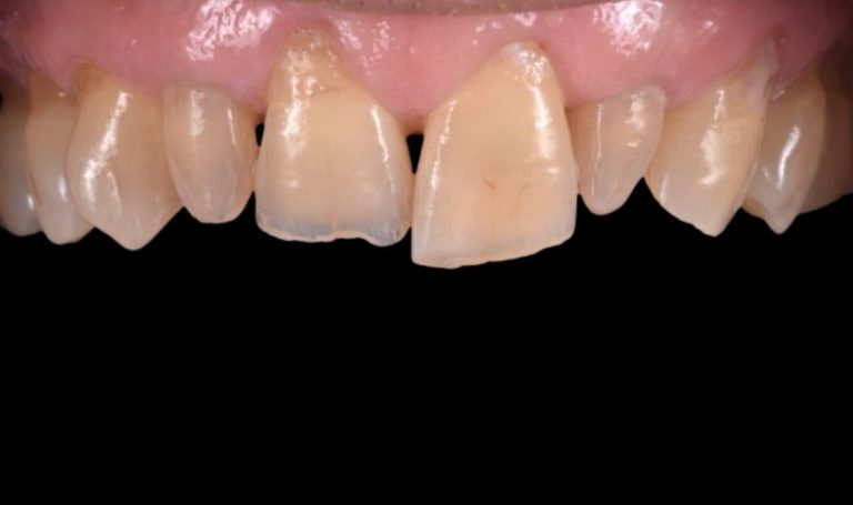 Faccette Dentali 47 Prima e dopo Faccette dentali a Novara e Varese