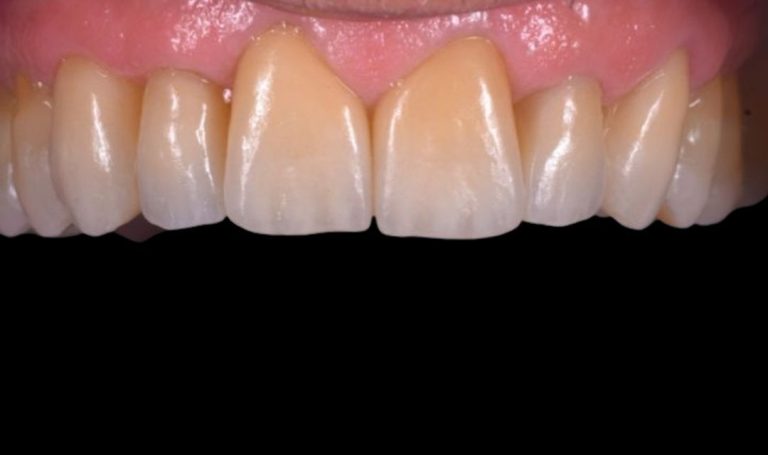 Faccette Dentali 48 Prima e dopo Faccette dentali a Novara e Varese