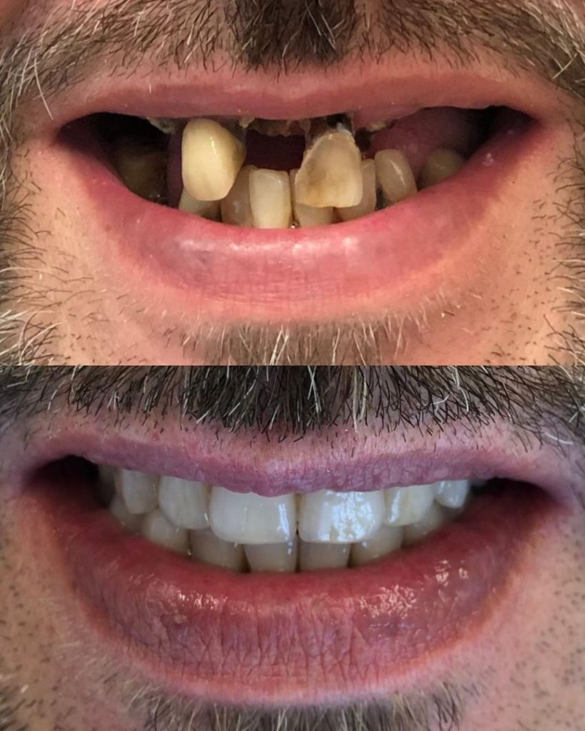 Implantologia 37 Prima e dopo - impianto dentale a Novara e Varese