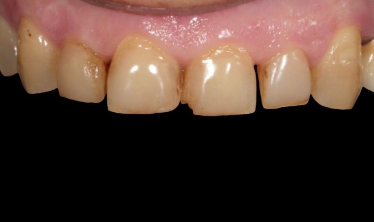 Faccette Dentali 37 Prima e dopo Faccette dentali a Novara e Varese