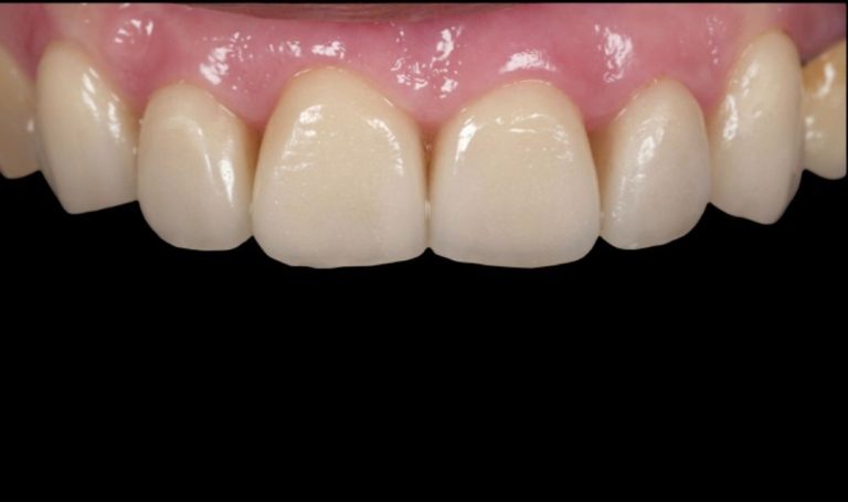 Faccette Dentali 38 Prima e dopo Faccette dentali a Novara e Varese