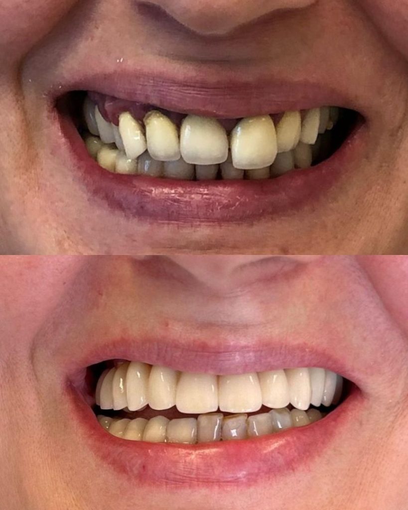 Implantologia 38 Prima e dopo - impianto dentale a Novara e Varese