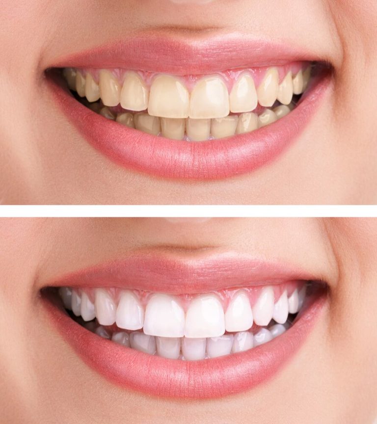 Blog 5 Sbiancamento dentale