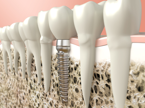 Blog 7 Impianto dentale