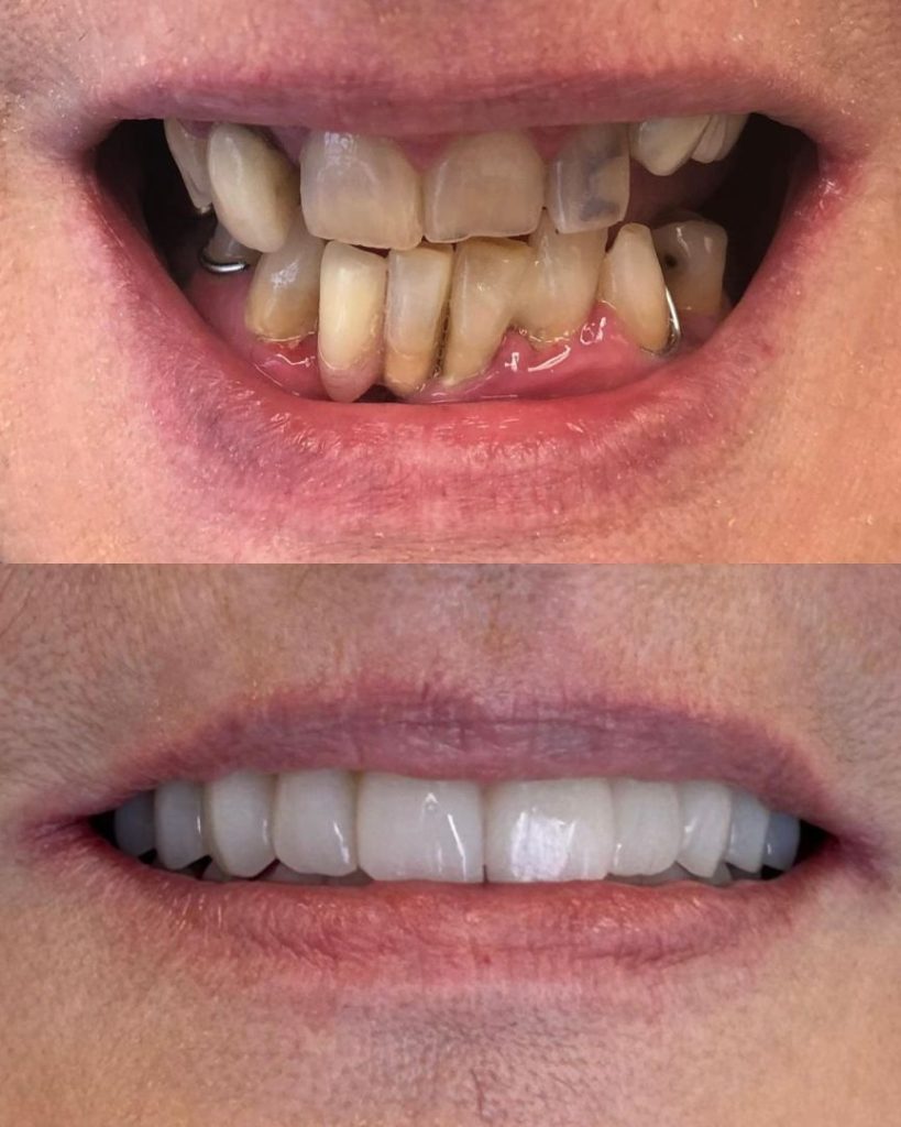 Implantologia 39 Prima e dopo - impianto dentale a Novara e Varese
