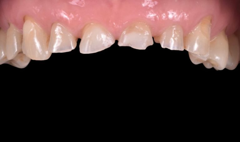 Faccette Dentali 39 Prima e dopo Faccette dentali a Novara e Varese
