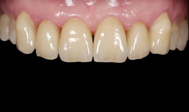 Faccette Dentali 40 Prima e dopo Faccette dentali a Novara e Varese