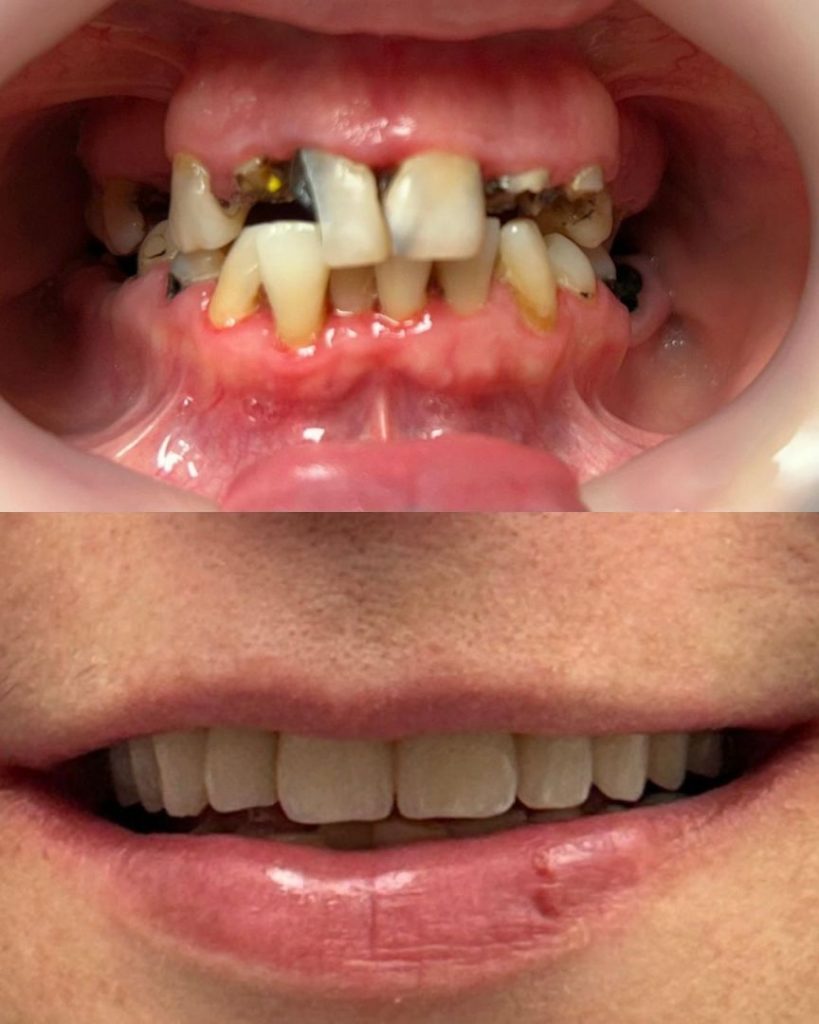 Implantologia 41 Prima e dopo - impianto dentale a Novara e Varese