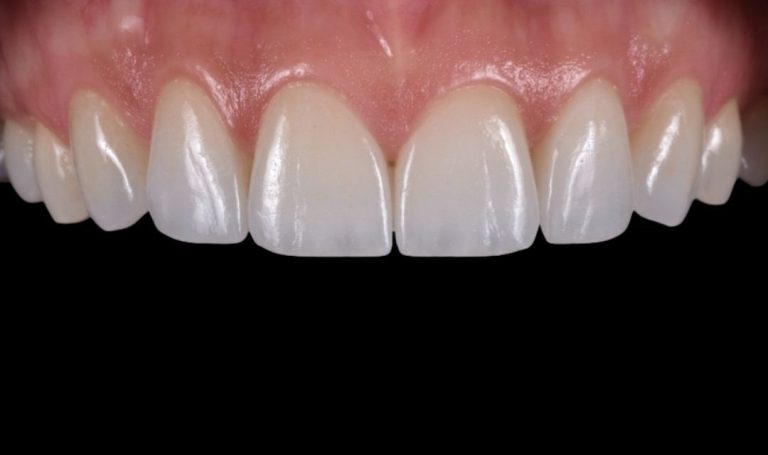 Faccette Dentali 42 Prima e dopo Faccette dentali a Novara e Varese
