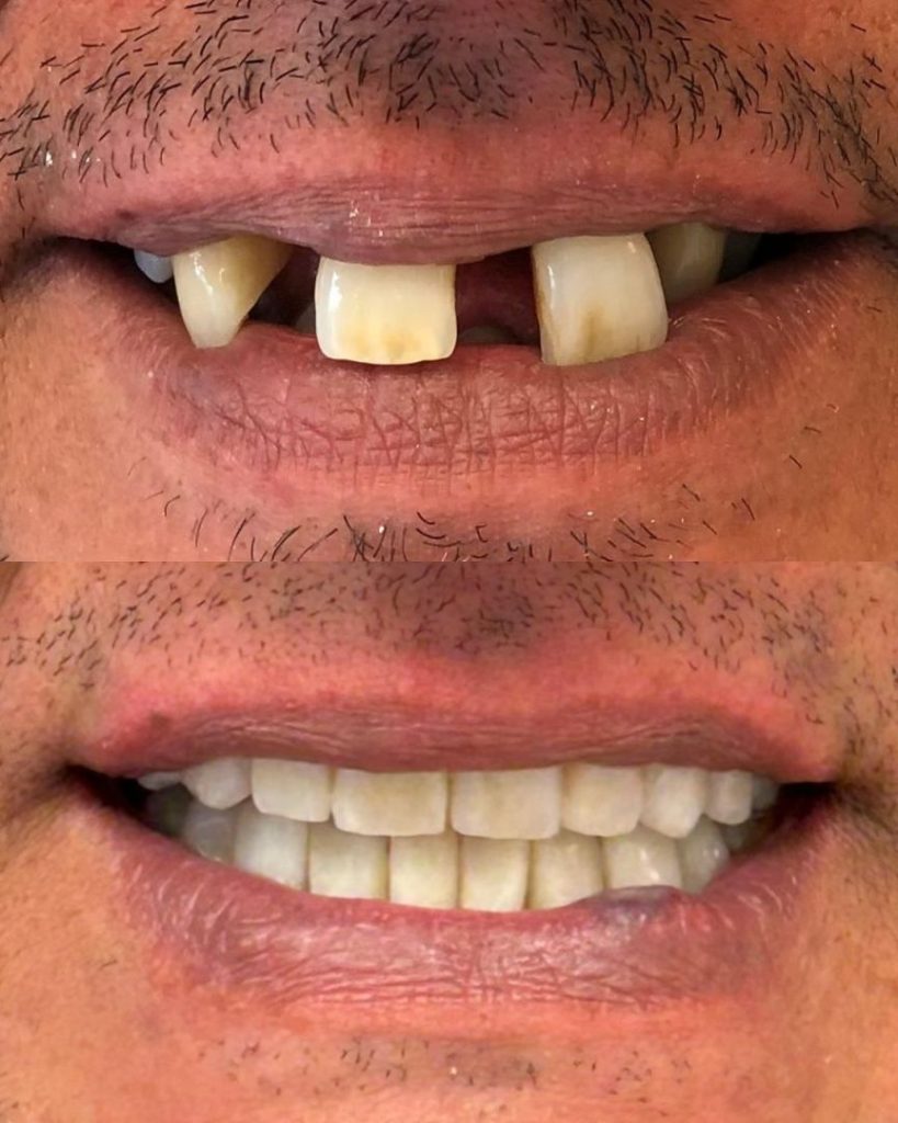 Implantologia 42 Prima e dopo - impianto dentale a Novara e Varese