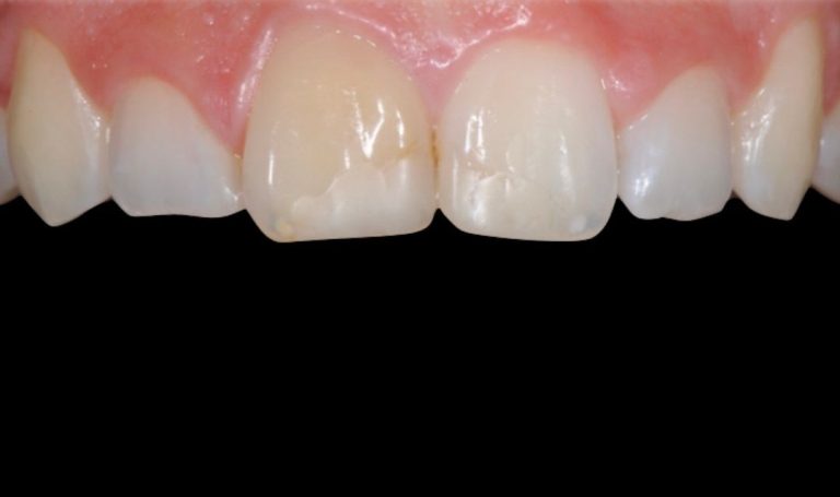 Faccette Dentali 43 Prima e dopo Faccette dentali a Novara e Varese