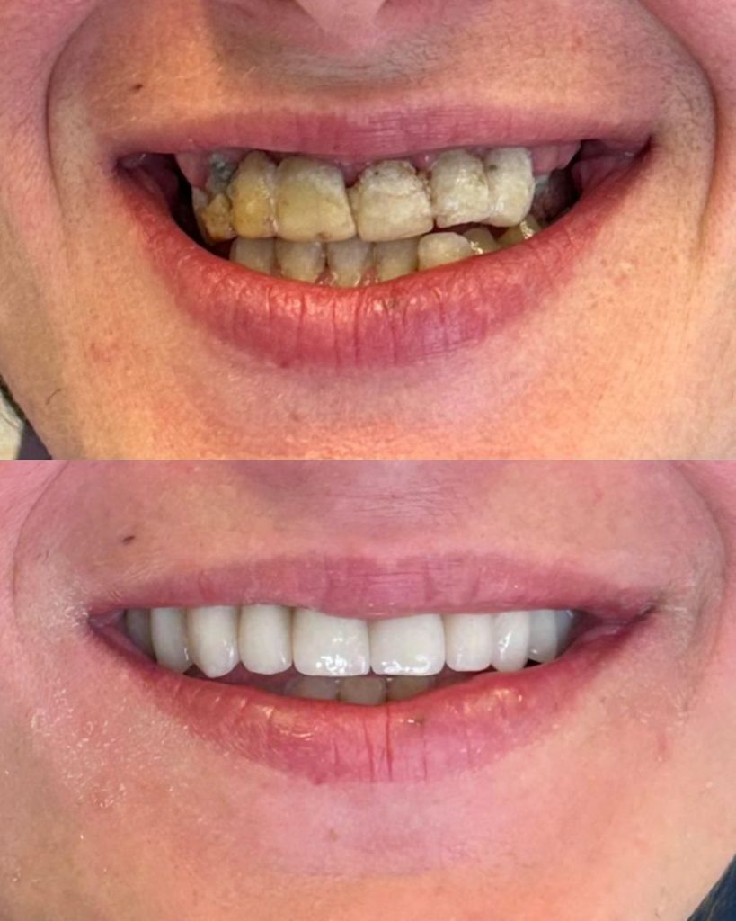 Implantologia 43 Prima e dopo - impianto dentale a Novara e Varese