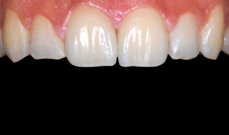 Faccette Dentali 44 Prima e dopo Faccette dentali a Novara e Varese