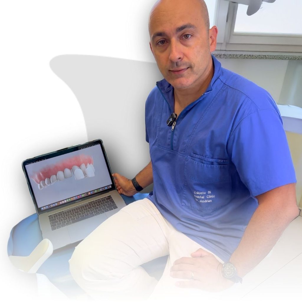 Faccette Dentali 5 faccette dentali a Novara e Varese