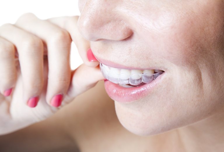 Blog 1 Clinica Odontoiatrica situata tra Novara e Varese | Ortodonzia invisibile
