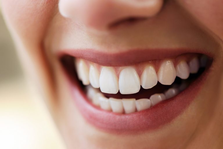 Blog 11 Faccette dentali