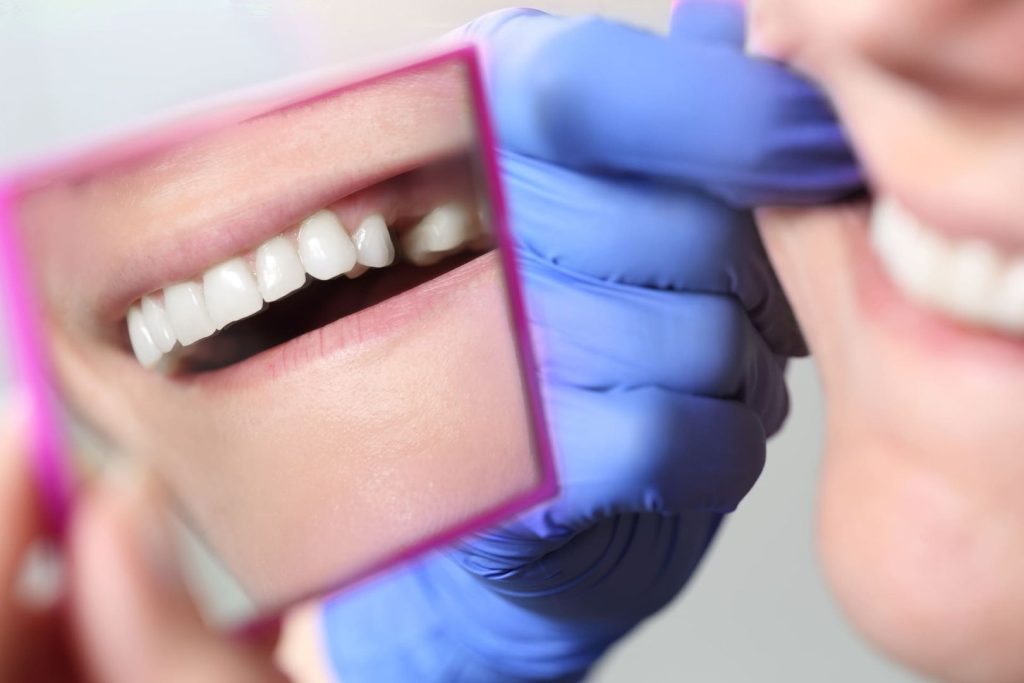 Impianto dentale e dolore: cosa aspettarsi prima, durante e dopo il trattamento 1 Impianto dentale e dolore