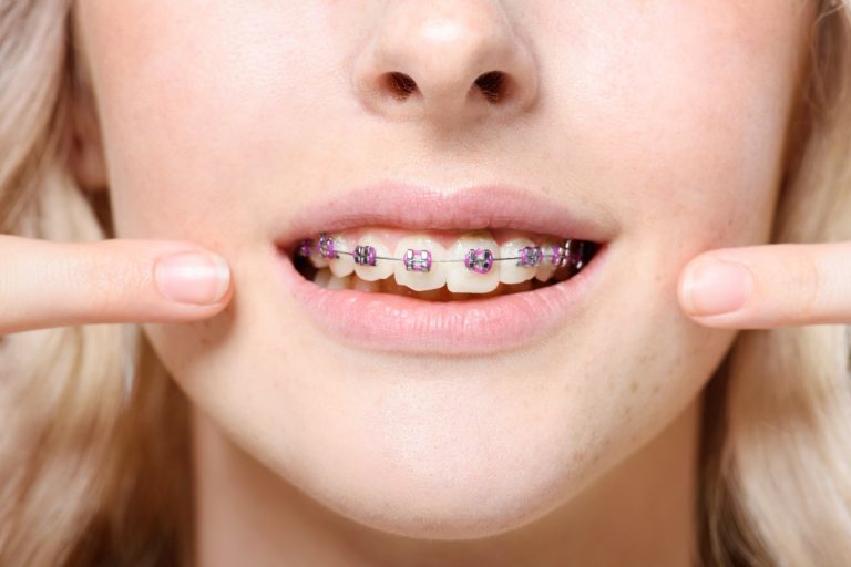 Blog 16 apparecchio per denti