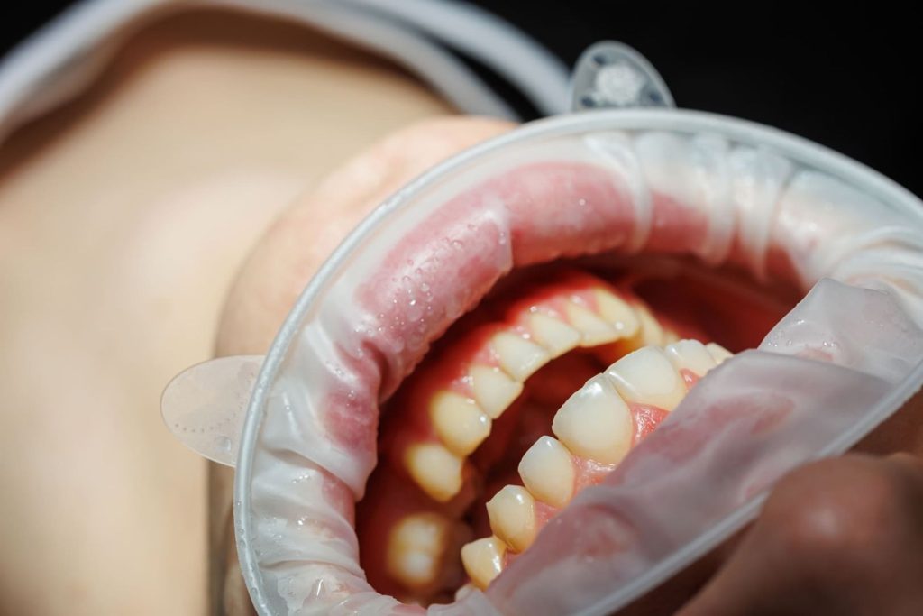 Come coprire i denti rovinati: soluzioni sicure ed efficaci 2 come coprire i denti rovinati