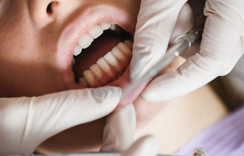 Sangue dalle gengive - innesto gengivale | Gengiva