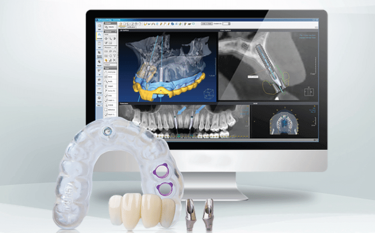 Blog 17 Impianto dentale senza bucare l'osso