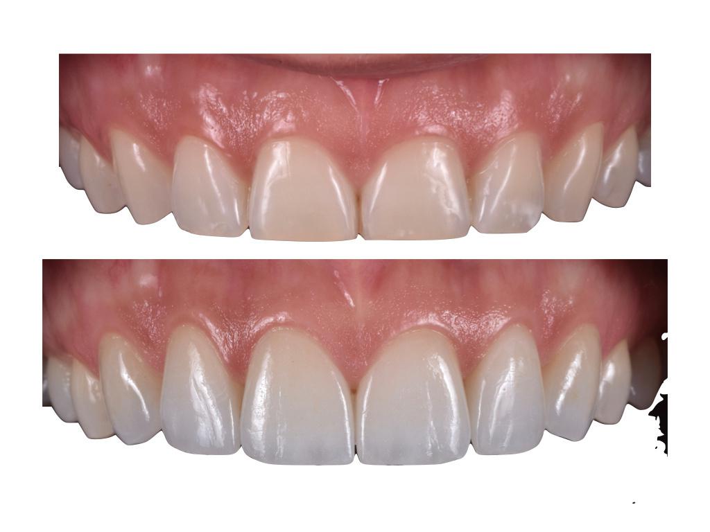 L’Estetica Dentale a Novara: Restauro biomimetico e innovazione: un approfondimento informativo a cura del Dott. Fabio Andrian 2 estetica dentale a Novara