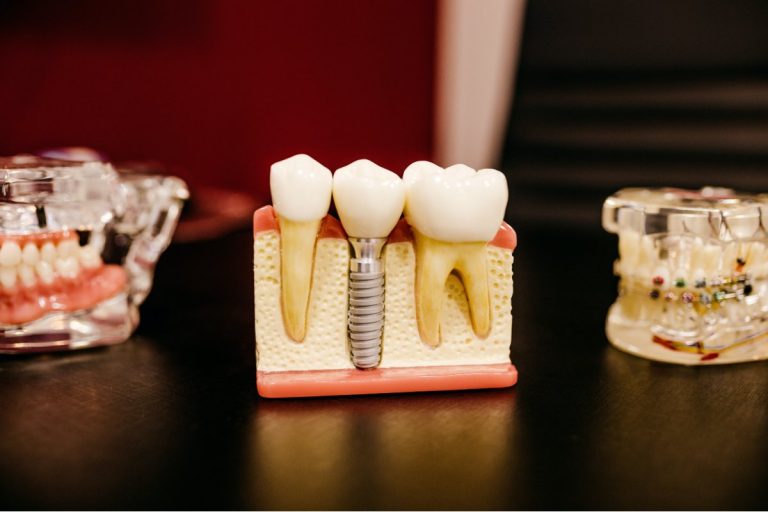 Blog 12 impianti dentali o dentiera