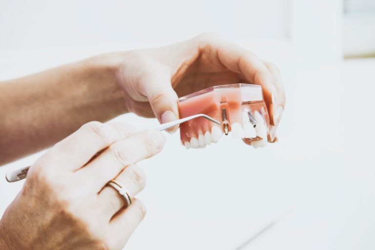 Blog 8 impianto dentale durata