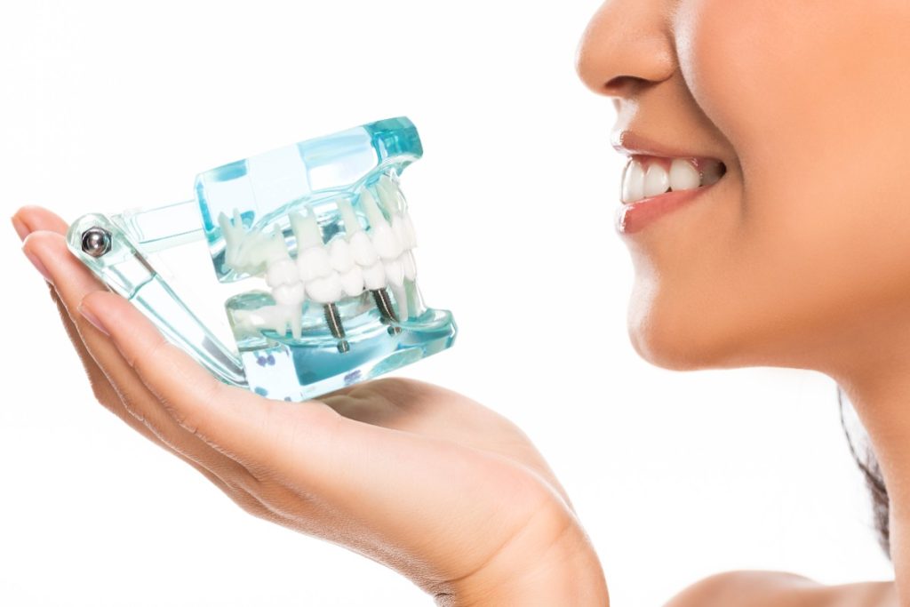 protesi su impianti dentali