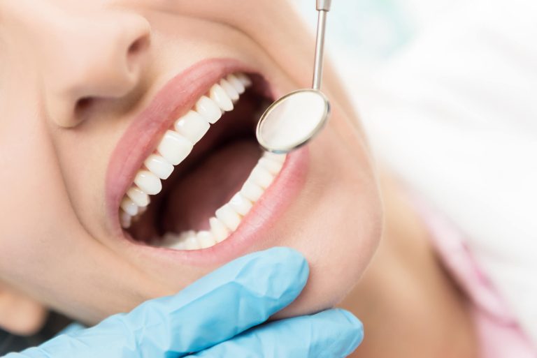 Blog 8 Sbiancamento dei denti