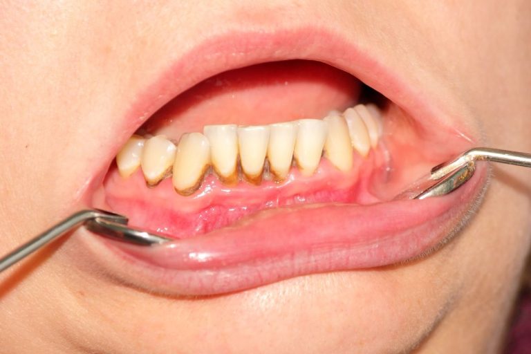 Blog 9 tartaro sui denti